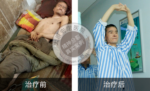 精神分裂症